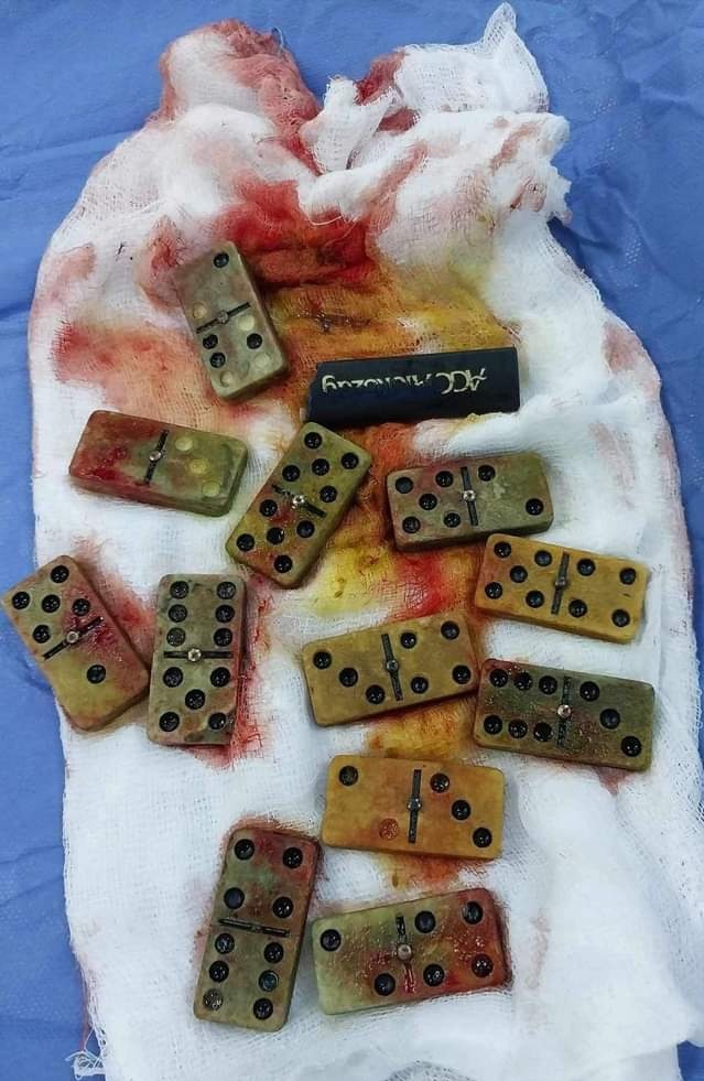 قطع دومينو وقداحات.. استخراج أجسام غريبة من معدة مريض في أربيل